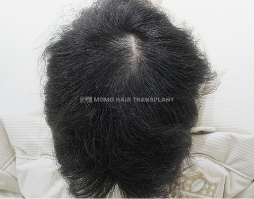 女性额头提升疤痕覆盖切开 after