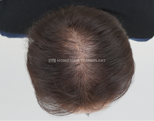 女性头顶植发 before