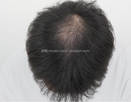 女性额头提升疤痕覆盖切开 before