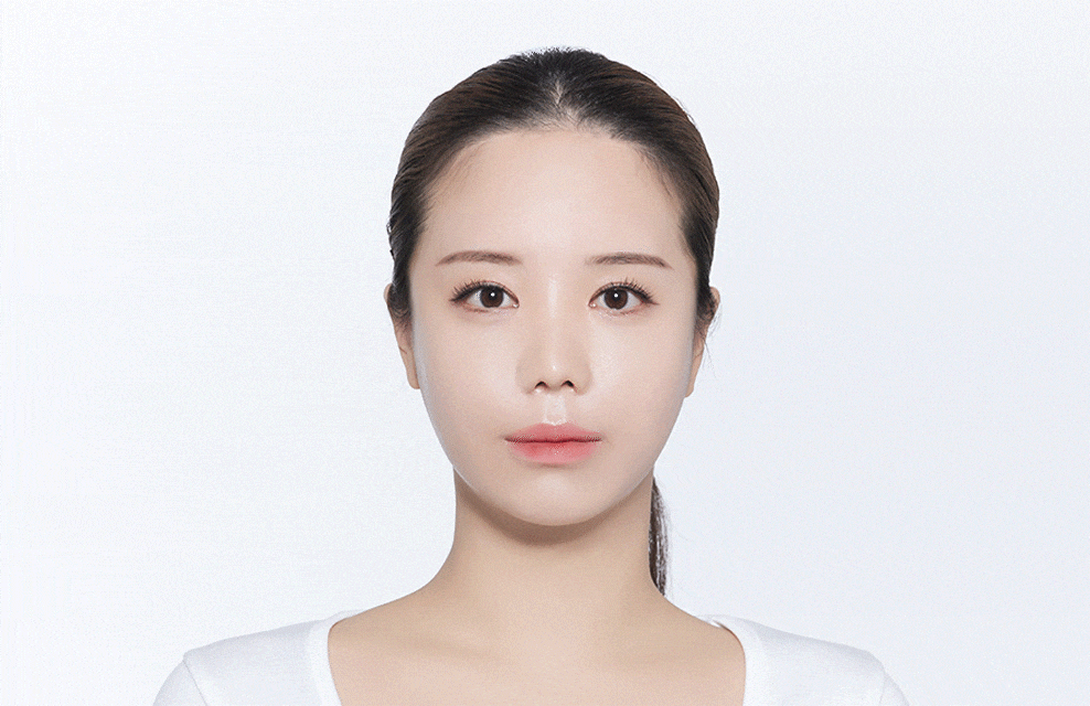 手術によるヘアライン変形