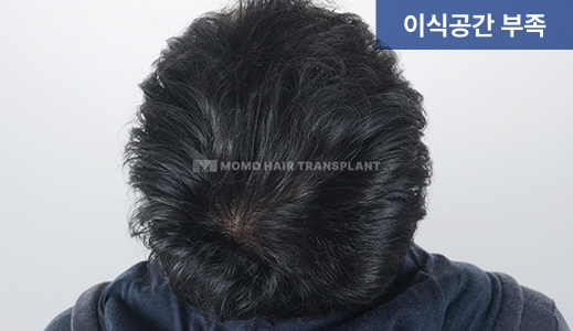 이식공간 부족