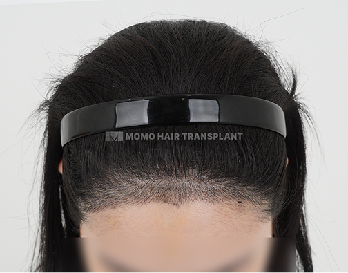 Contour surgery scar cover non-incisional hair transplant after