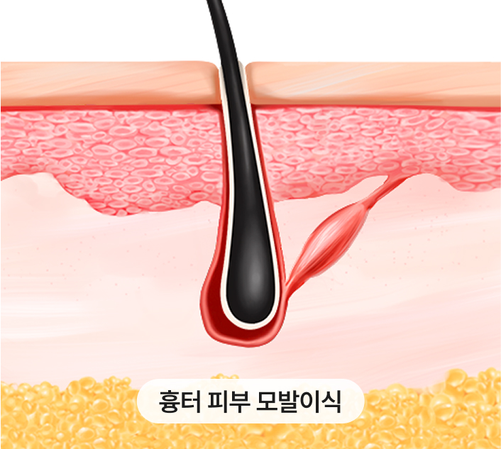 Hairline deformation due to surgery