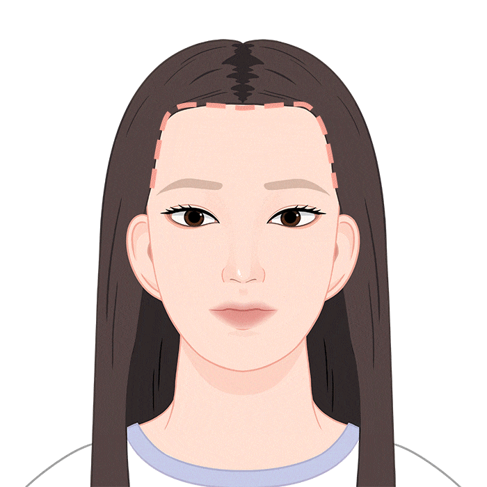 Scar cover hair transplant surgery process 03
