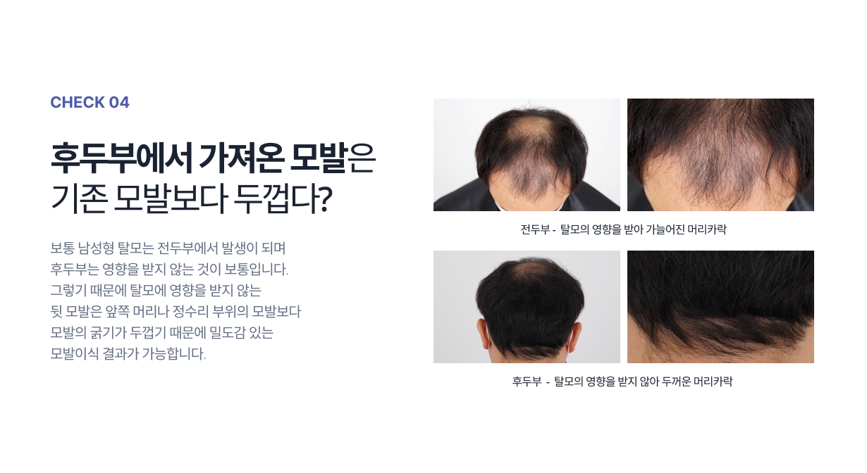 check04. 후두부에서 가져온 모발은 기존 모발보다 두껍다? 보통 남성형 탈모는 전두부에서 발생이 되며 후두부는 영향을 받지 않는 것이 보통입니다. 그렇기 때문에 탈모에 영향을 받지 않는 뒷 모발은 앞쪽 머리나 정수리 부위의 모발보다 모발의 굵기가 두껍기 때문에 밀도감 있는 모발이식 결과가 가능합니다.